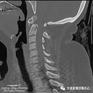 【病例】游离齿状突/齿状突小骨1例CT影像表现