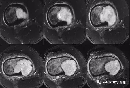 【病例】软骨粘液样纤维瘤1例影像诊断分析
