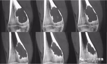 【病例】软骨粘液样纤维瘤1例影像诊断分析