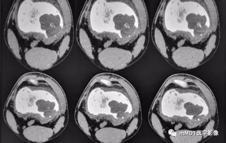 【病例】软骨粘液样纤维瘤1例影像诊断分析