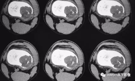 【病例】软骨粘液样纤维瘤1例影像诊断分析