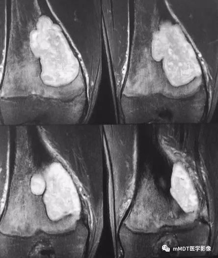 【病例】软骨粘液样纤维瘤1例影像诊断分析