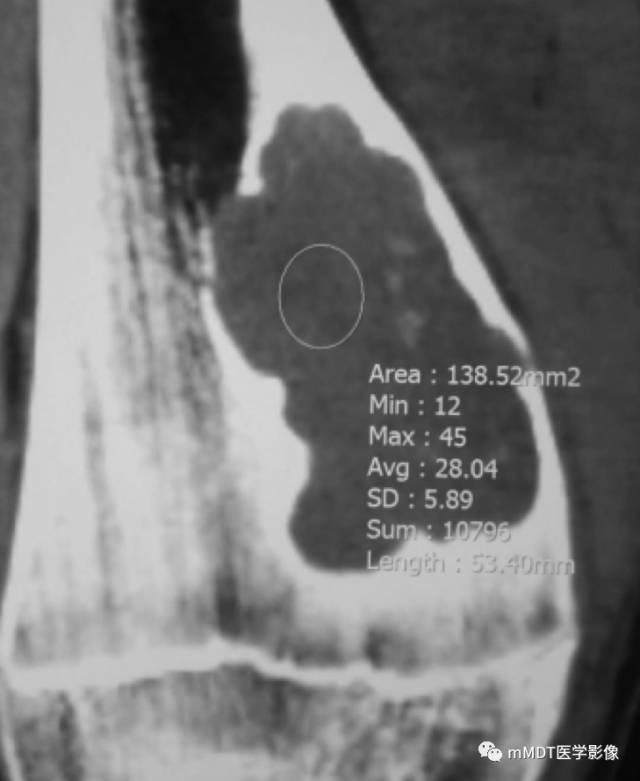 【病例】软骨粘液样纤维瘤1例影像诊断分析