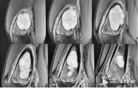 【病例】软骨粘液样纤维瘤1例影像诊断分析