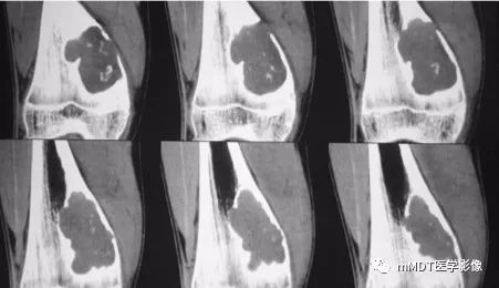 【病例】软骨粘液样纤维瘤1例影像诊断分析