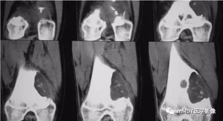 【病例】软骨粘液样纤维瘤1例影像诊断分析