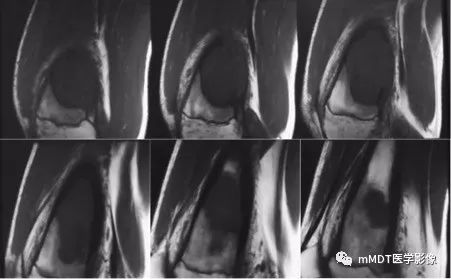 【病例】软骨粘液样纤维瘤1例影像诊断分析