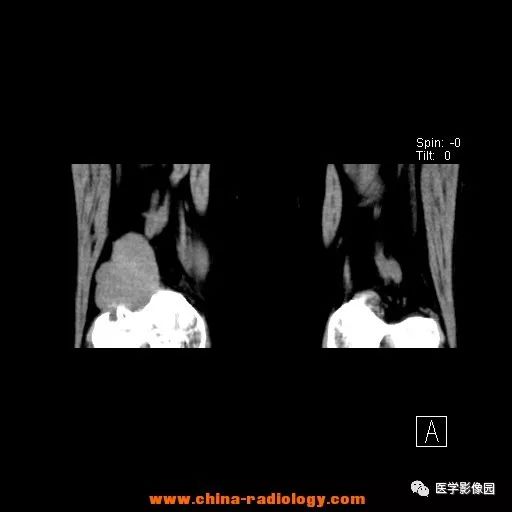 【病例】股骨下端梭形细胞瘤1例CT