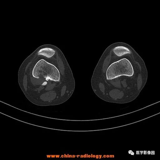 【病例】股骨下端梭形细胞瘤1例CT