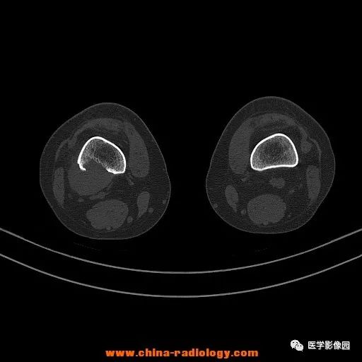 【病例】股骨下端梭形细胞瘤1例CT