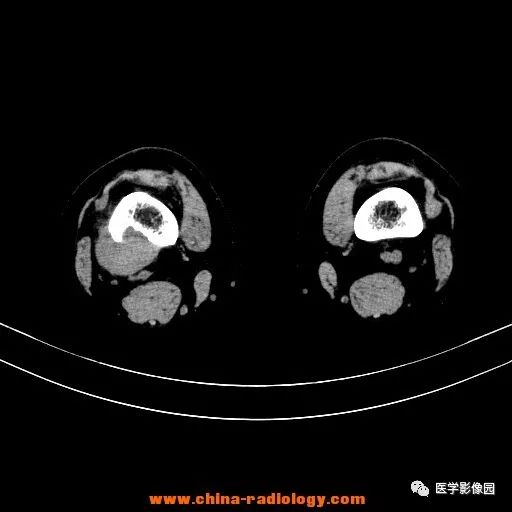 【病例】股骨下端梭形细胞瘤1例CT