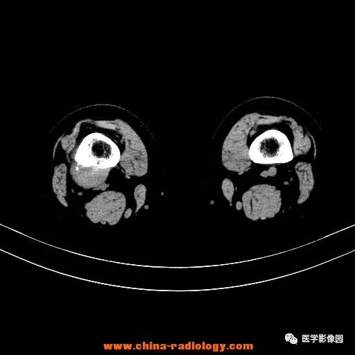 【病例】股骨下端梭形细胞瘤1例CT