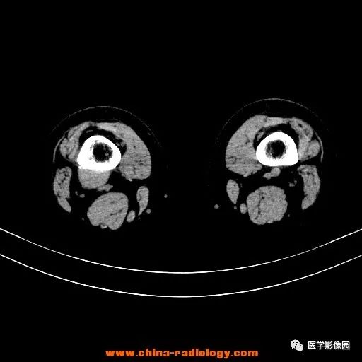 【病例】股骨下端梭形细胞瘤1例CT
