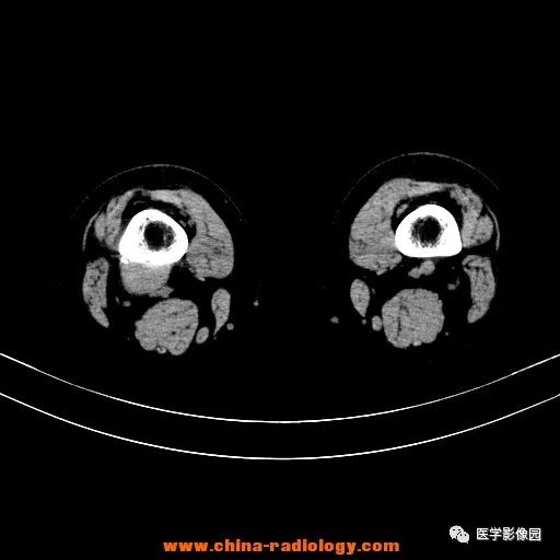 【病例】股骨下端梭形细胞瘤1例CT