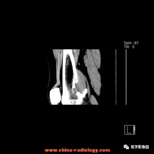 【病例】股骨下端梭形细胞瘤1例CT