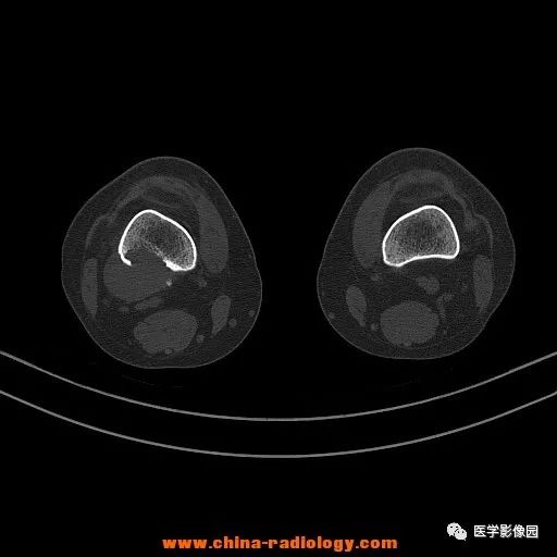 【病例】股骨下端梭形细胞瘤1例CT