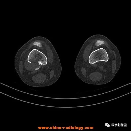 【病例】股骨下端梭形细胞瘤1例CT