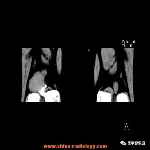 【病例】股骨下端梭形细胞瘤1例CT