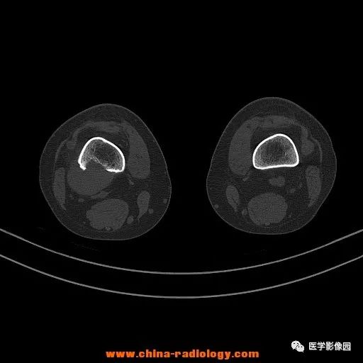 【病例】股骨下端梭形细胞瘤1例CT