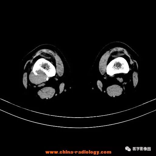 【病例】股骨下端梭形细胞瘤1例CT