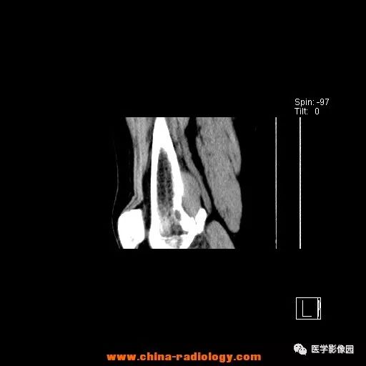 【病例】股骨下端梭形细胞瘤1例CT