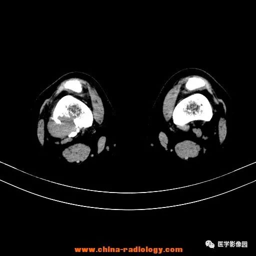 【病例】股骨下端梭形细胞瘤1例CT
