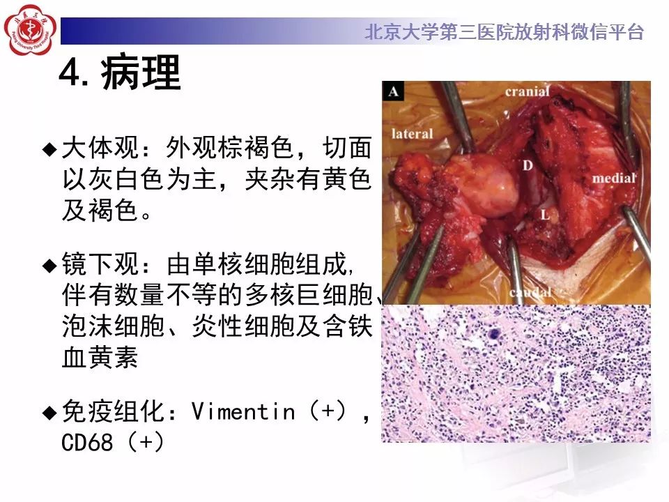 【病例】脊柱腱鞘巨细胞瘤1例CT及MR影像诊断