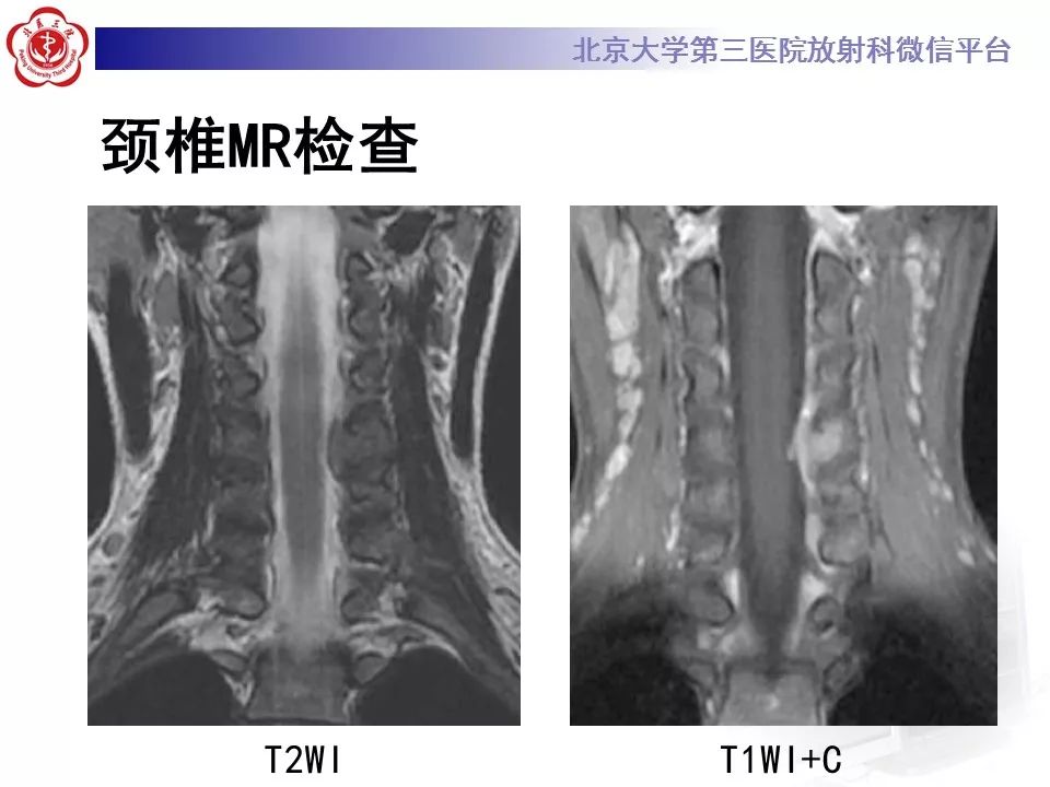 【病例】脊柱腱鞘巨细胞瘤1例CT及MR影像诊断