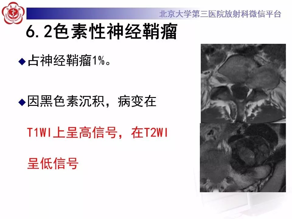 【病例】脊柱腱鞘巨细胞瘤1例CT及MR影像诊断