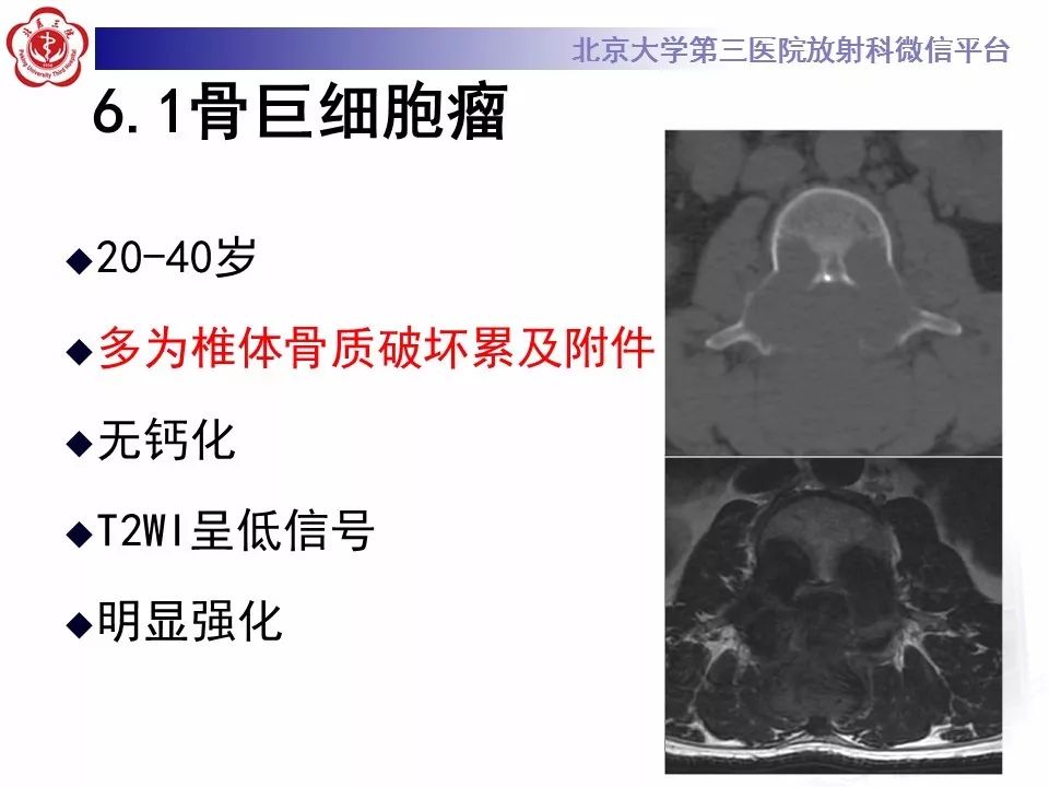 【病例】脊柱腱鞘巨细胞瘤1例CT及MR影像诊断