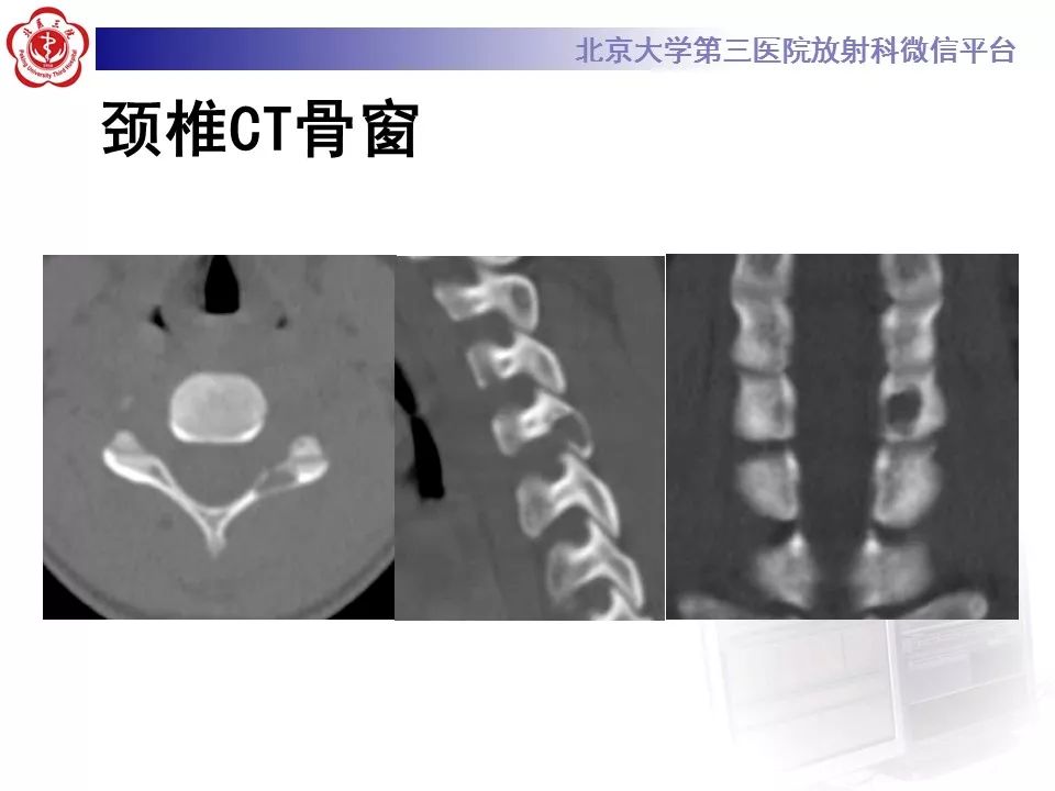 【病例】脊柱腱鞘巨细胞瘤1例CT及MR影像诊断
