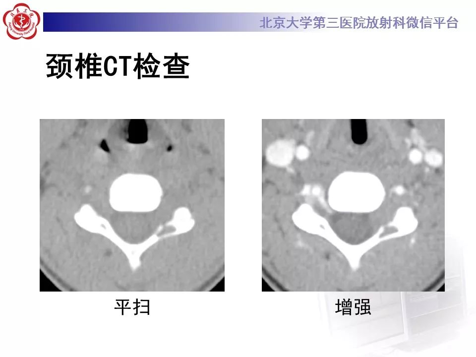 【病例】脊柱腱鞘巨细胞瘤1例CT及MR影像诊断