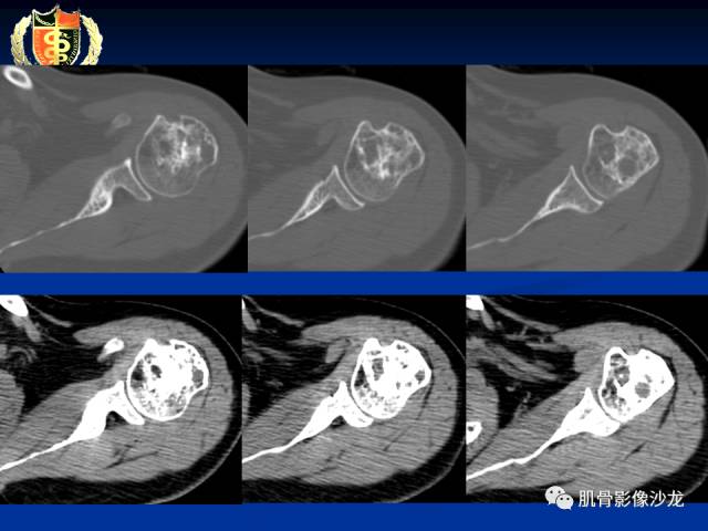 【病例】骨淋巴瘤及软骨肉瘤两例CT及MR影像表现