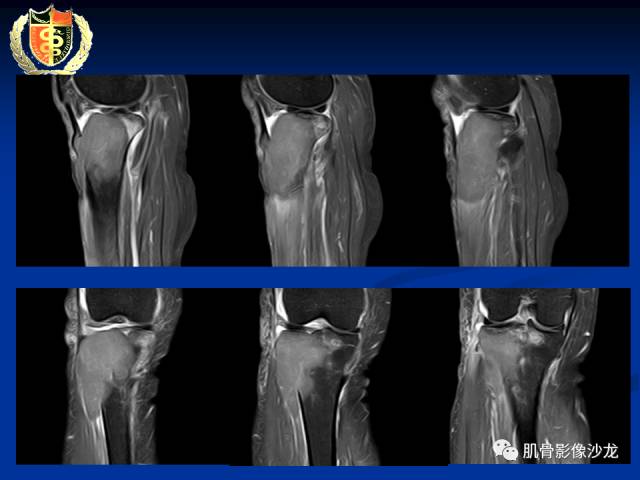 【病例】骨淋巴瘤及软骨肉瘤两例CT及MR影像表现