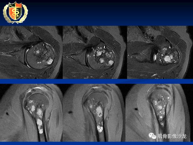 【病例】骨淋巴瘤及软骨肉瘤两例CT及MR影像表现