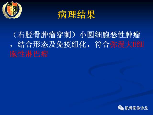 【病例】骨淋巴瘤及软骨肉瘤两例CT及MR影像表现