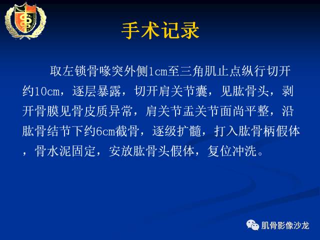 【病例】骨淋巴瘤及软骨肉瘤两例CT及MR影像表现