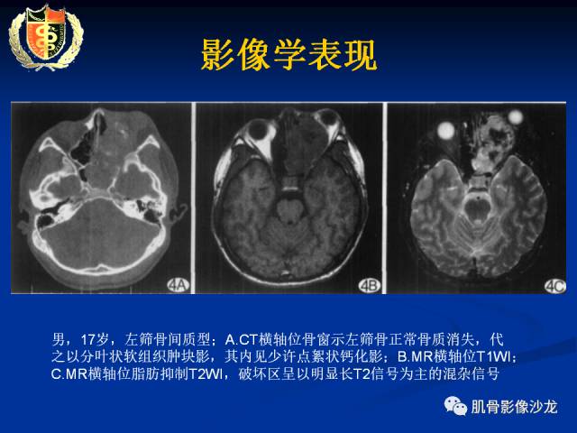 【病例】骨淋巴瘤及软骨肉瘤两例CT及MR影像表现