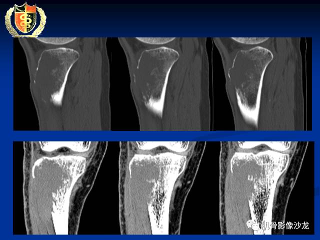 【病例】骨淋巴瘤及软骨肉瘤两例CT及MR影像表现