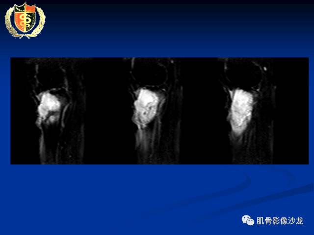 【病例】骨淋巴瘤及软骨肉瘤两例CT及MR影像表现