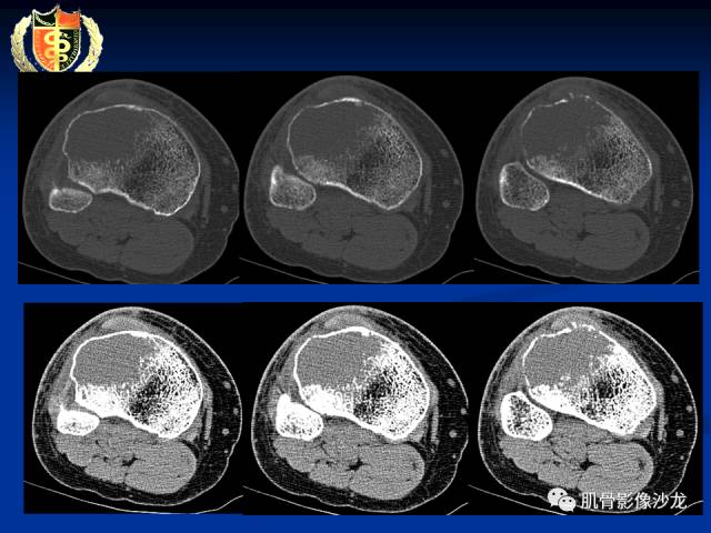 【病例】骨淋巴瘤及软骨肉瘤两例CT及MR影像表现