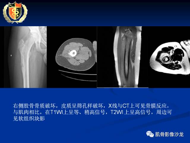 【病例】骨淋巴瘤及软骨肉瘤两例CT及MR影像表现