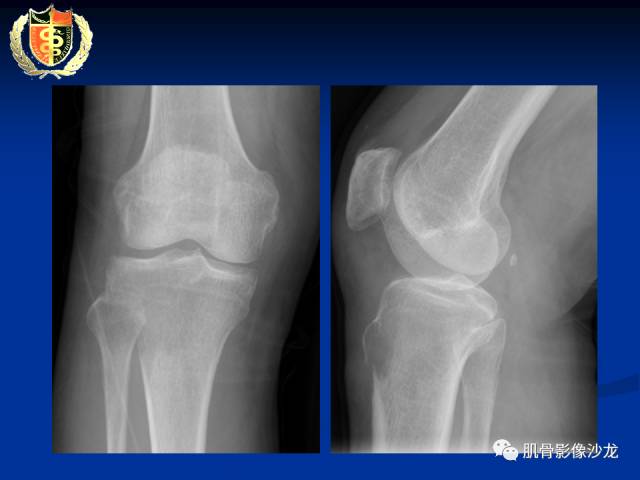 【病例】骨淋巴瘤及软骨肉瘤两例CT及MR影像表现