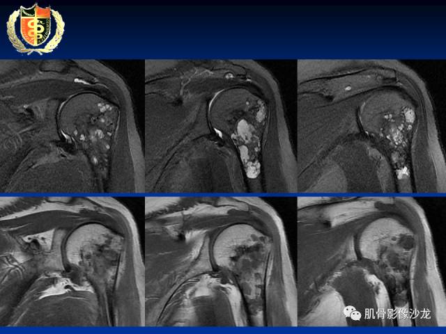 【病例】骨淋巴瘤及软骨肉瘤两例CT及MR影像表现