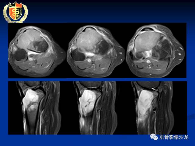 【病例】骨淋巴瘤及软骨肉瘤两例CT及MR影像表现