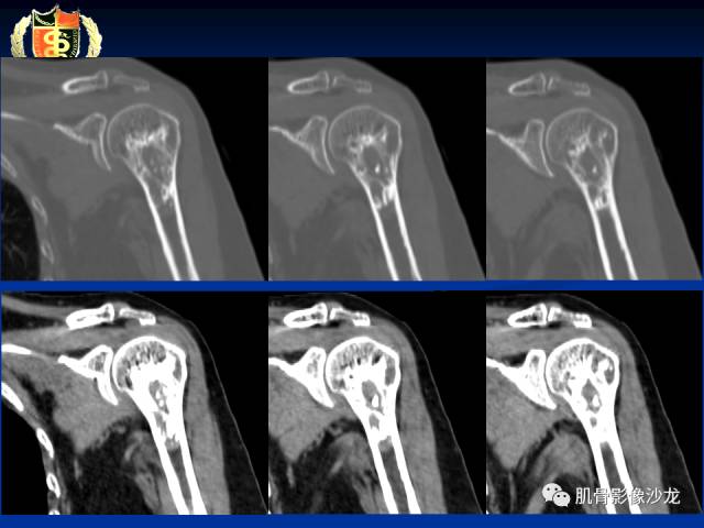【病例】骨淋巴瘤及软骨肉瘤两例CT及MR影像表现