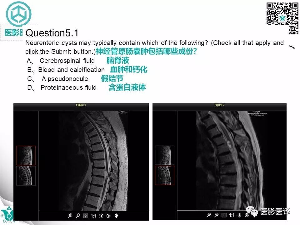 【病例】椎管神经管原肠囊肿1例MR