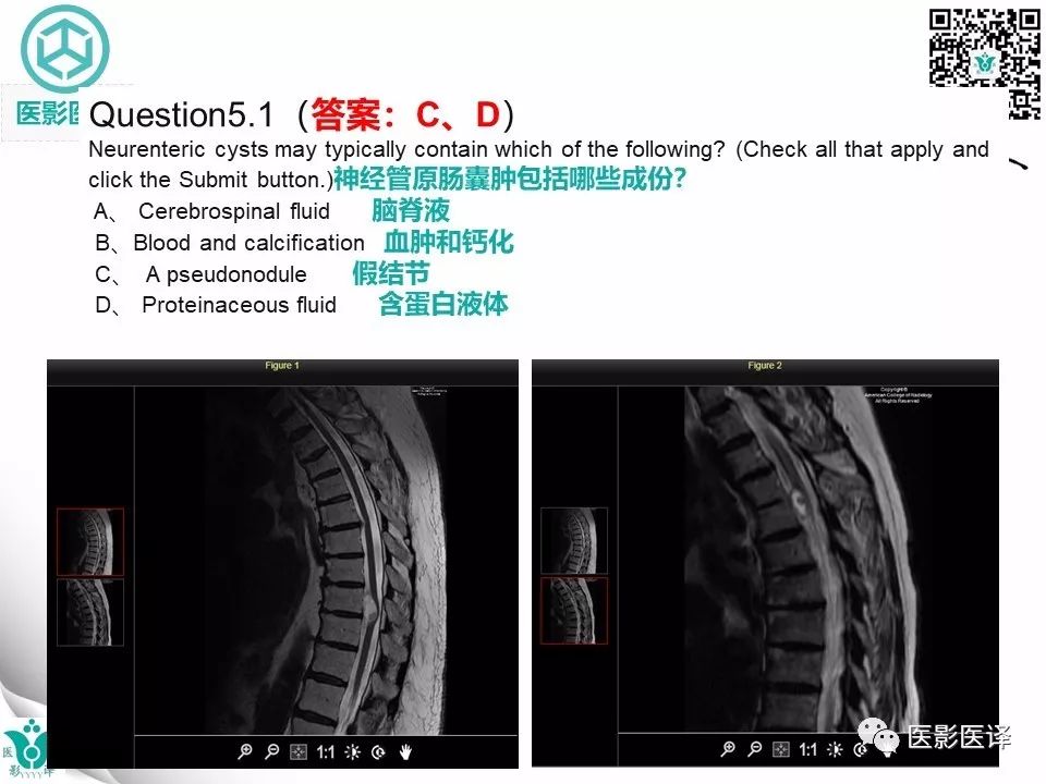 【病例】椎管神经管原肠囊肿1例MR