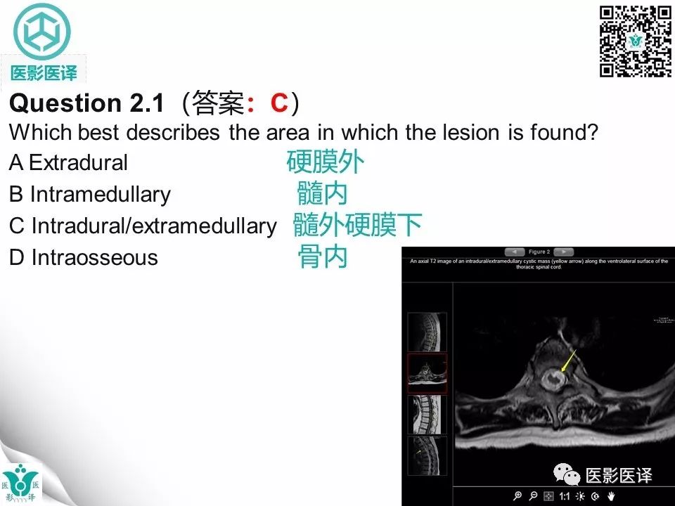 【病例】椎管神经管原肠囊肿1例MR