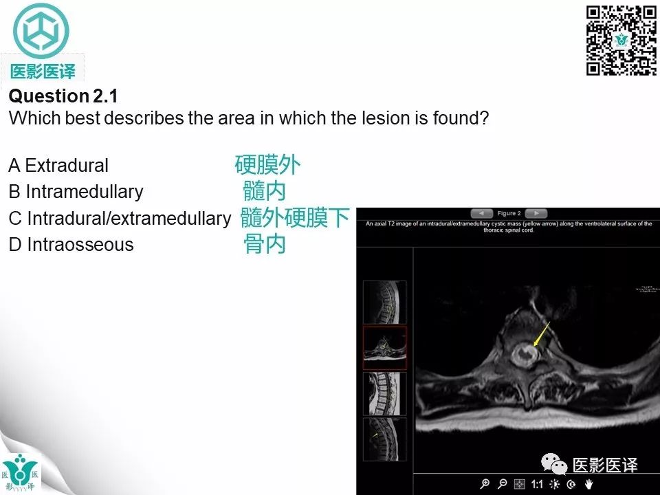 【病例】椎管神经管原肠囊肿1例MR